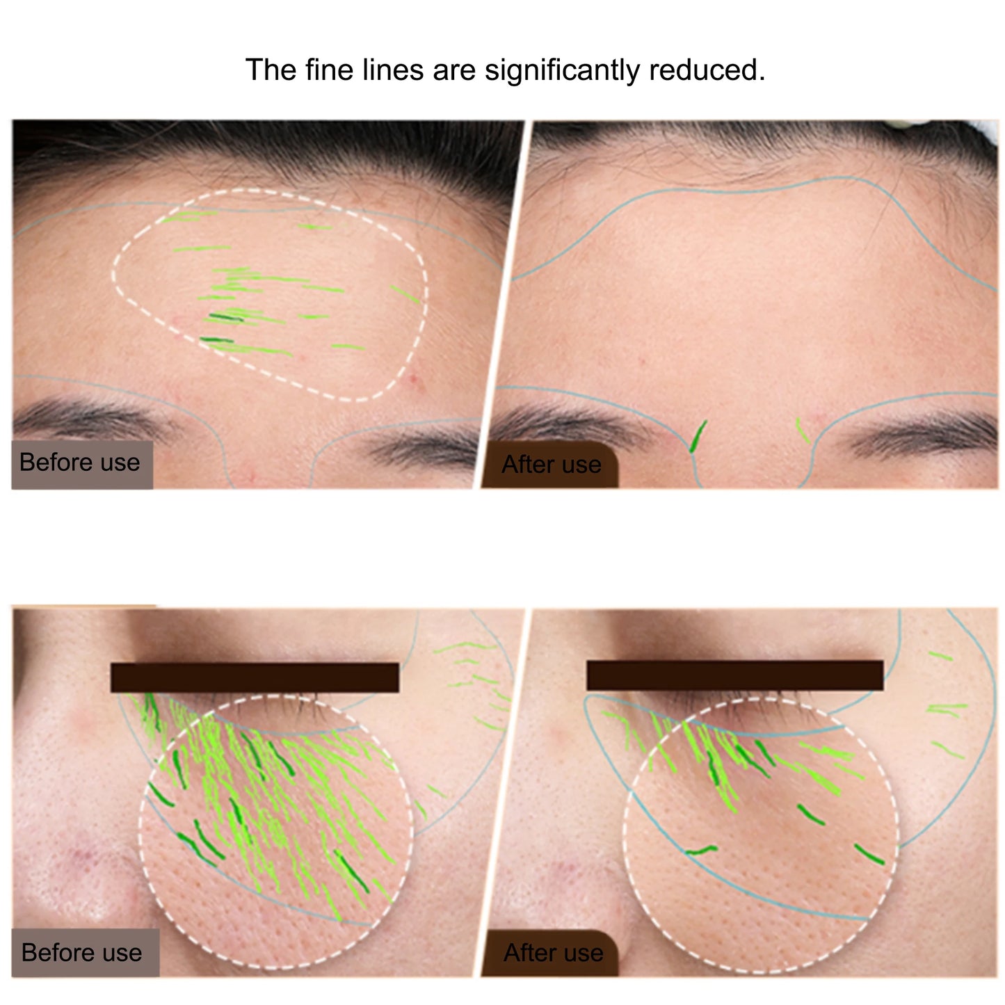 EMS Facial Body RF Machine – Face Lifting & Skin Tightening Device